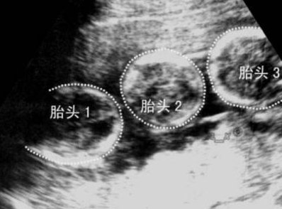 深圳做三代试管大概要多少钱？